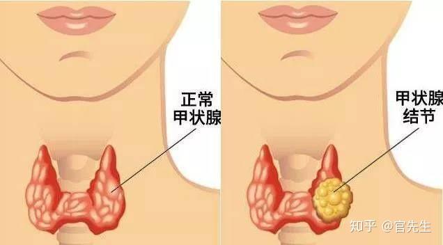 甲状腺最新