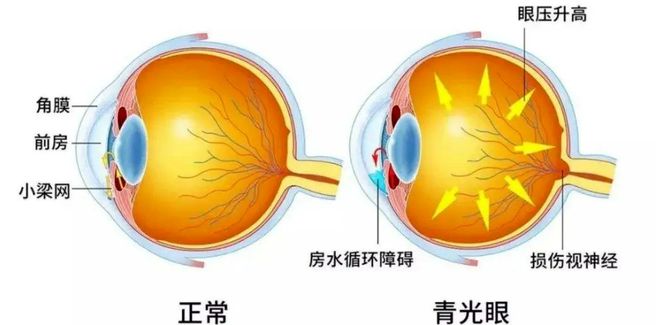 开角型青光眼最新治疗