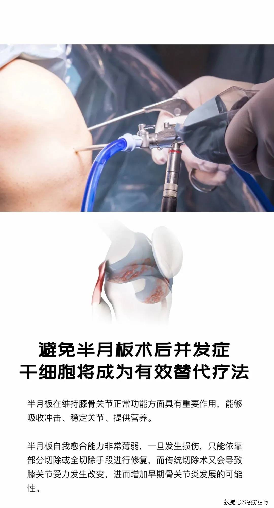 半月板再生术最新进展